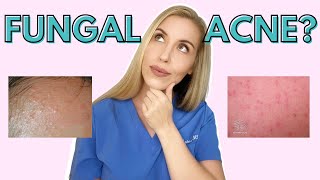 Do YOU have Fungal Acne  Dermatologist Talks Symptoms and Treatments [upl. by Nnairrek]