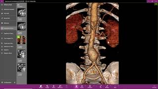 Abdominal aortic aneurysm ultrasound [upl. by Kaile886]