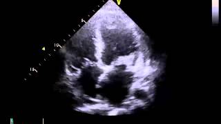 Echocardiography to Assess MitralValve Leaflets  NEJM [upl. by Aihpos694]