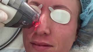 Fraxel Restore Laser Treatment [upl. by Britney229]