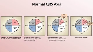 Intro to EKG Interpretation  Rate and Axis [upl. by Hoover]