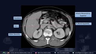 TOMOGRAFIA AXIAL BASICA DE ABDOMEN Y PELVIS [upl. by Ahcsropal]