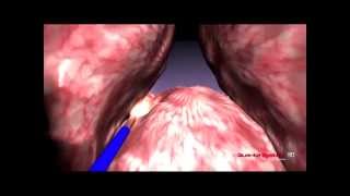 Quanta System  BPH  3D Enucleation median lobe  Thulium Laser [upl. by Mellie812]