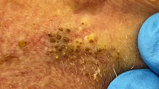 Extremely Clogged Pores Extracted  Contour Dermatology [upl. by Schell700]