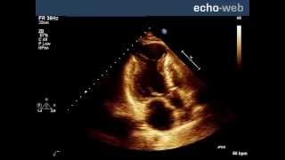 EchoWeb Left Ventricular Aneurysm [upl. by Tterrab]