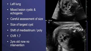 TMT Echogenic Lungs  Dr Alpana Joshi  CCAM  Pulmonary Sequestration  CPAM  Fetal Medicine [upl. by Stranger]