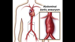 Abdominal Aortic Aneurysm AAA [upl. by Cock]