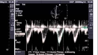 Point of Care Echo Stroke Volume Determination [upl. by Cliff562]