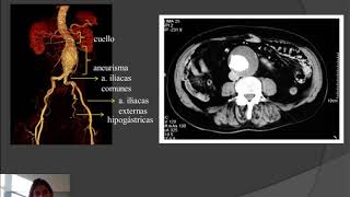 Aneurisma da Aorta Abdominal  AAA  Cirurgia Endovascular [upl. by Jeniffer460]