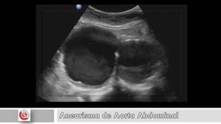 Aneurisma Aorta Abdominal Doppler [upl. by Liddle124]