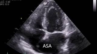 Atrial Septal Aneurysm ASA [upl. by Zielsdorf342]