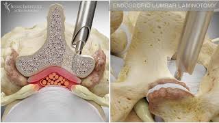 Endoscopic Lumbar Laminotomy  Spine Institute of North America [upl. by Amiaj430]