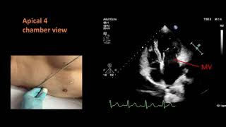 Standard views for a basic echocardiogram [upl. by Gregoire]