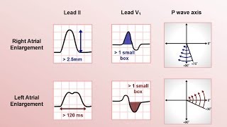 Intro to EKG Interpretation  Chamber Enlargement [upl. by Eidac836]