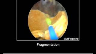 Bladder Stone Holmium Laser [upl. by Syl]