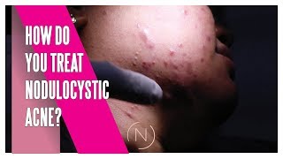 How Do You Treat Nodulocystic Acne  Houston Dermatology [upl. by Belden]