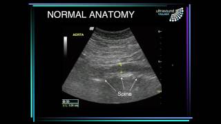 Aneurisma de aorta abdominal [upl. by Sherard]