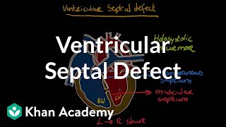 Ventricular septal defect  Circulatory System and Disease  NCLEXRN  Khan Academy [upl. by Airyk]