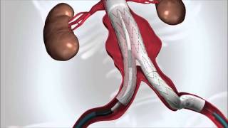 Aneurisma de Aorta [upl. by Silloc]