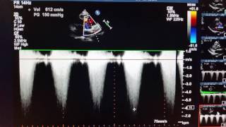 Echocardiogram  doublechambered right ventricle DCRV [upl. by Eiramlirpa]