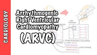 Arrhythmogenic right ventricular cardiomyopathy ARVC  pathophysiology investigations treatment [upl. by Nollahs715]