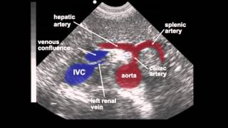 Aneurisma da aorta abdominal [upl. by Lairret642]