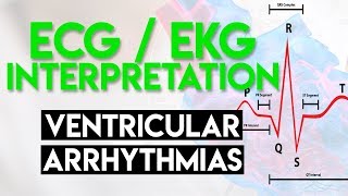 Ventricular Arrhythmias  ECG EKG Interpretation Part 5 [upl. by Trebmal200]